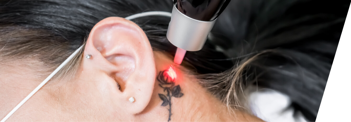 Tattoo Removal in Florence, KY