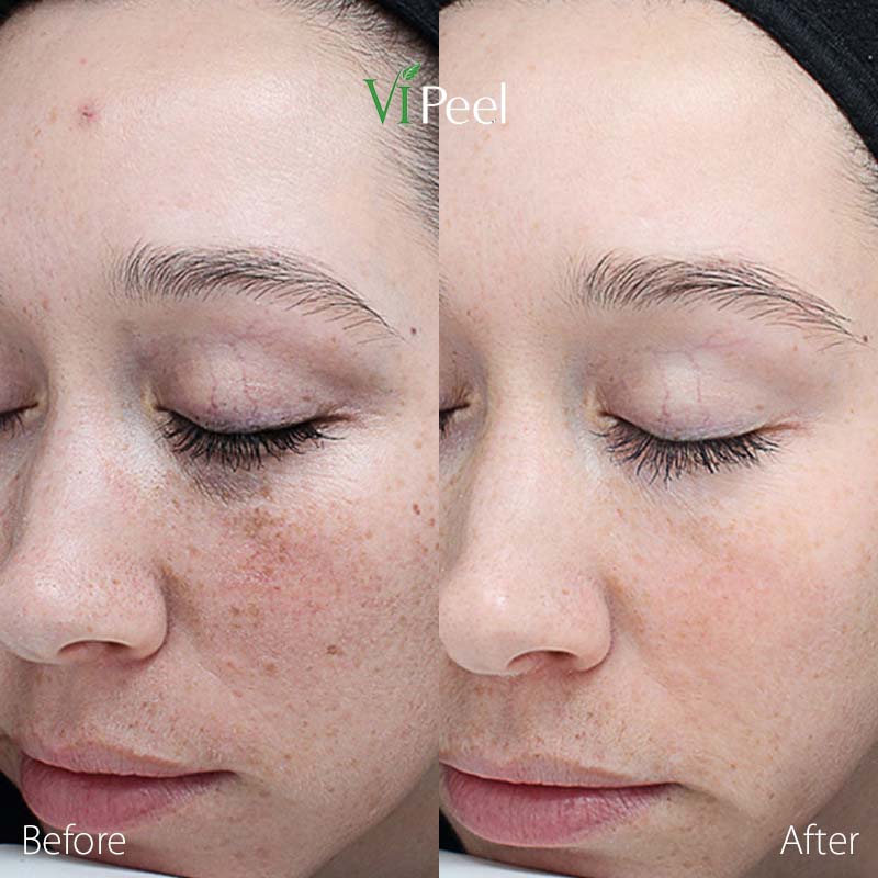 Chemical Peels Derm Aesthetics of Northern Kentucky