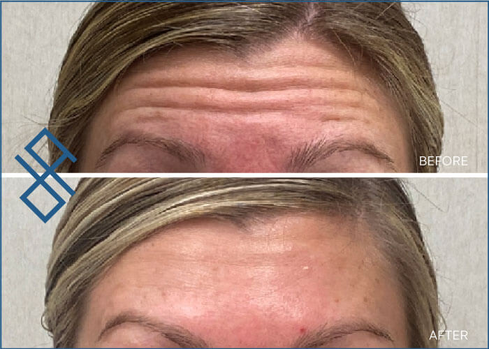 Botox Injection Before and After