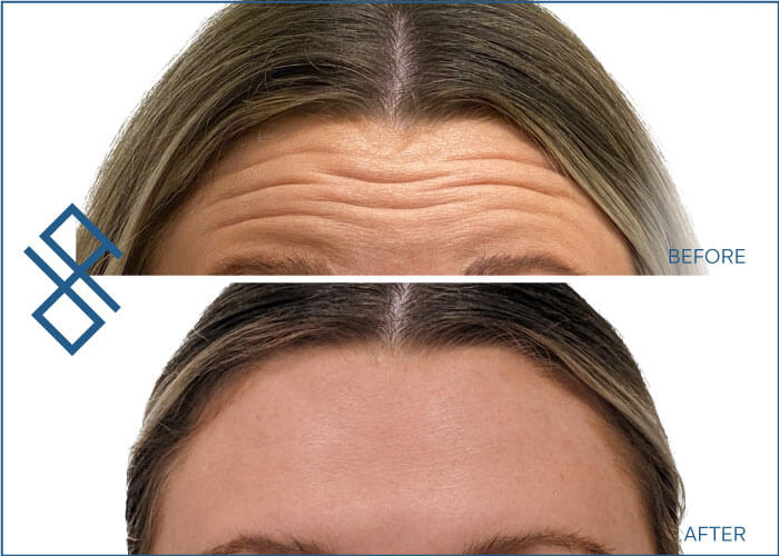 Xeomin Forehead Before and After