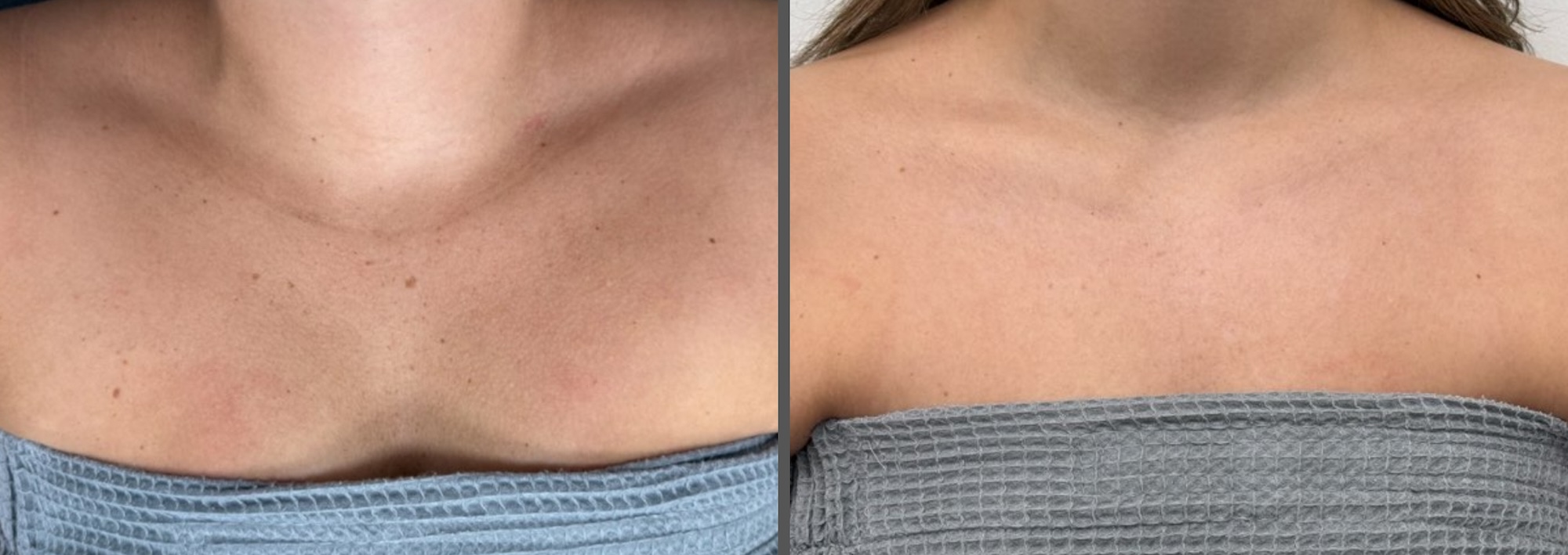 Small Bbl Before & After Archive | Dermatology Aesthetics of Northern Kentucky