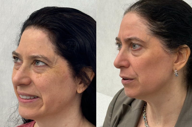 Two side-by-side images of Moxi laser before and after near Cincinnati showing a woman's face with reduced wrinkles after treatment.