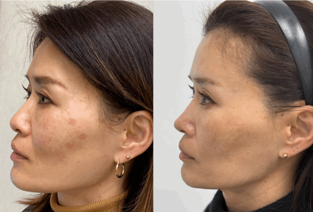 Two side-by-side images of Moxi laser before and after near Cincinnati showing a woman's face with reduced hyperpigmentation after treatment.