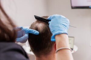 A female Dermatology Aesthetics of Northern Kentucky provider identifies the severity of a male patient's hair loss before administering PRF injections near Cincinnati.